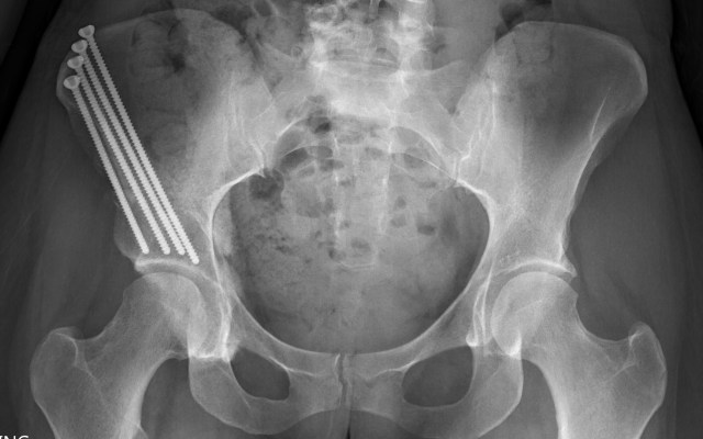 hip xray 2:27