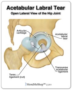 29434a82d56d19a4359628aa3394bb42--hip-pain-relief-hip-replacement